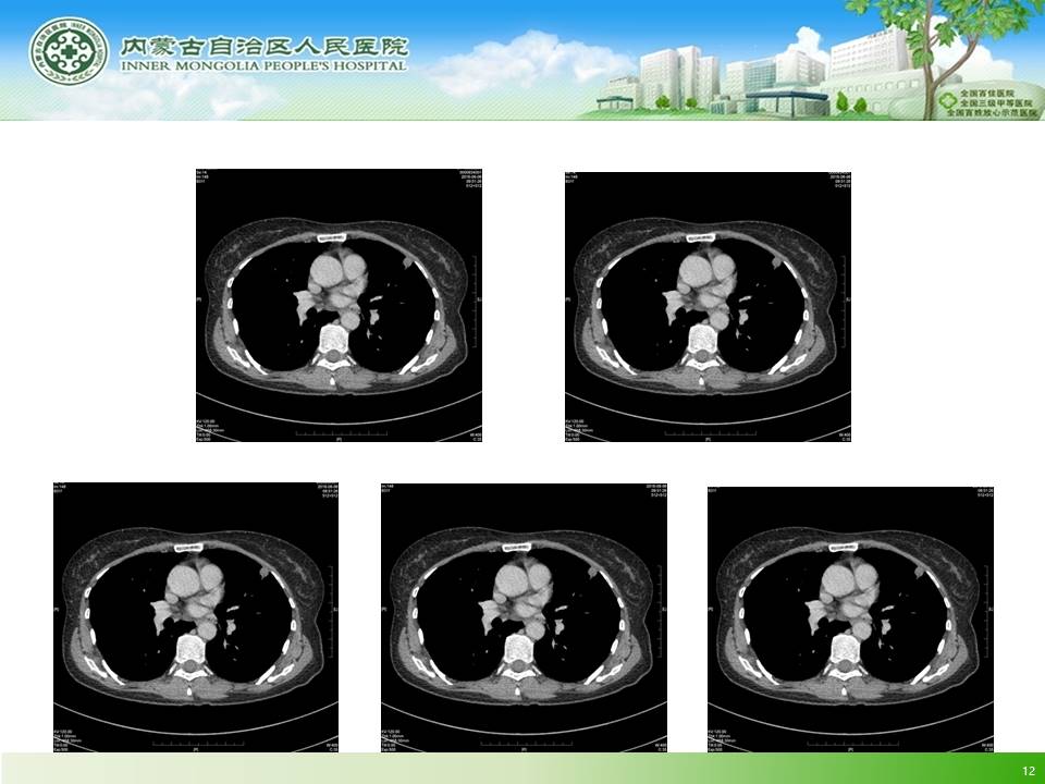 【病例】左肺上叶结核球1例CT