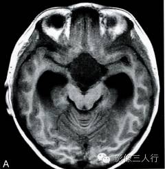 【病例】鞍上池室管膜瘤1例MR影像表现分析