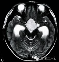 【病例】鞍上池室管膜瘤1例MR影像表现分析 【病例】鞍上池室管膜瘤1例MR影像表现分析