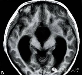 【病例】鞍上池室管膜瘤1例MR影像表现分析 【病例】鞍上池室管膜瘤1例MR影像表现分析