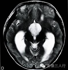 【病例】鞍上池室管膜瘤1例MR影像表现分析 【病例】鞍上池室管膜瘤1例MR影像表现分析