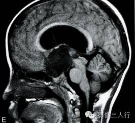 【病例】鞍上池室管膜瘤1例MR影像表现分析 【病例】鞍上池室管膜瘤1例MR影像表现分析