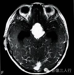 【病例】鞍上池室管膜瘤1例MR影像表现分析 【病例】鞍上池室管膜瘤1例MR影像表现分析