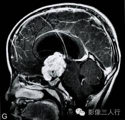 【病例】鞍上池室管膜瘤1例MR影像表现分析 【病例】鞍上池室管膜瘤1例MR影像表现分析