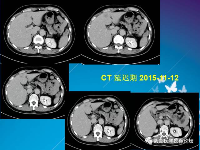 【病例】肝左叶胆管细胞癌1例CT及MR影像表现 【病例】肝左叶胆管细胞癌1例CT及MR影像表现