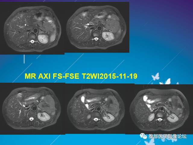 【病例】肝左叶胆管细胞癌1例CT及MR影像表现 【病例】肝左叶胆管细胞癌1例CT及MR影像表现
