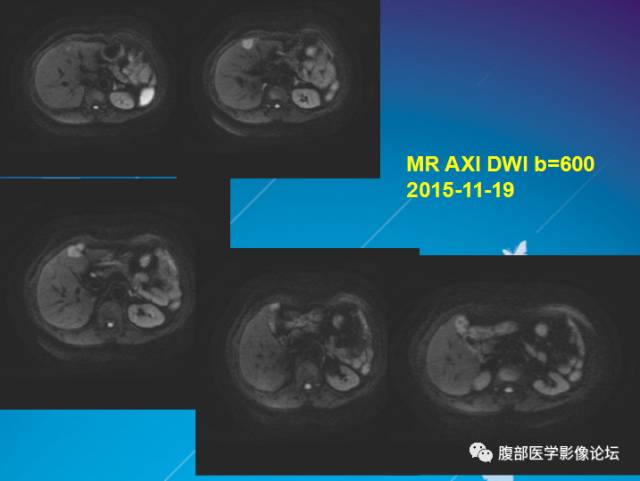 【病例】肝左叶胆管细胞癌1例CT及MR影像表现 【病例】肝左叶胆管细胞癌1例CT及MR影像表现