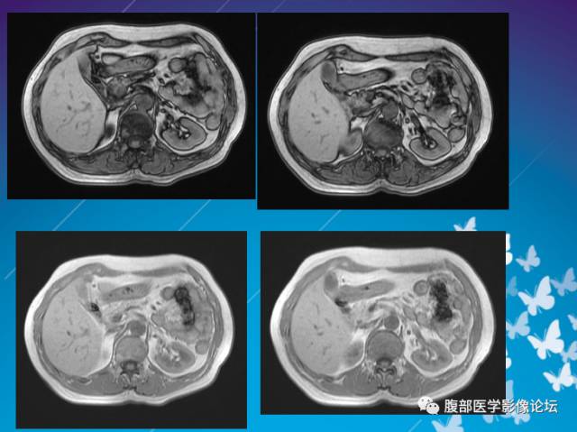 【病例】肝左叶胆管细胞癌1例CT及MR影像表现 【病例】肝左叶胆管细胞癌1例CT及MR影像表现