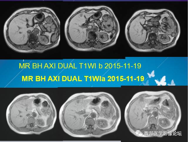 【病例】肝左叶胆管细胞癌1例CT及MR影像表现 【病例】肝左叶胆管细胞癌1例CT及MR影像表现