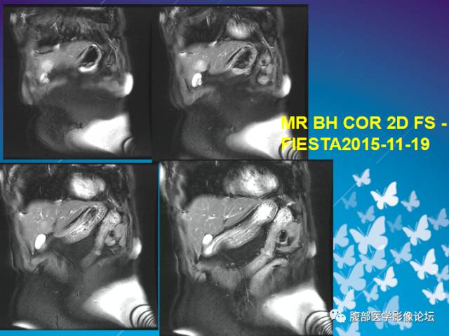 【病例】肝左叶胆管细胞癌1例CT及MR影像表现 【病例】肝左叶胆管细胞癌1例CT及MR影像表现