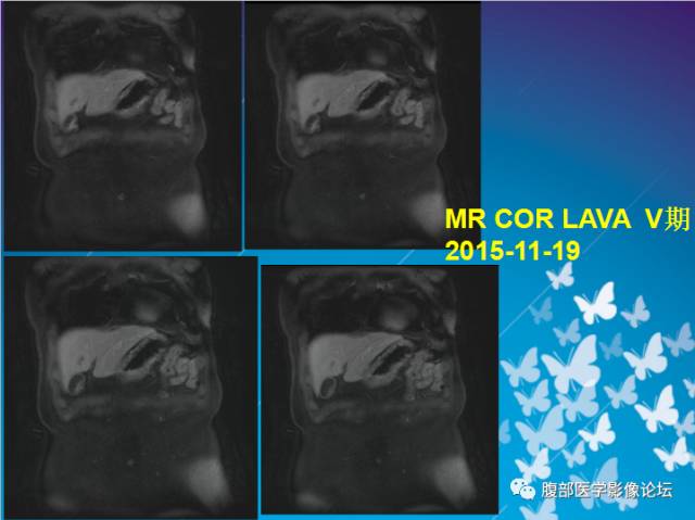 【病例】肝左叶胆管细胞癌1例CT及MR影像表现 【病例】肝左叶胆管细胞癌1例CT及MR影像表现