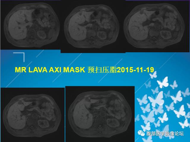 【病例】肝左叶胆管细胞癌1例CT及MR影像表现 【病例】肝左叶胆管细胞癌1例CT及MR影像表现