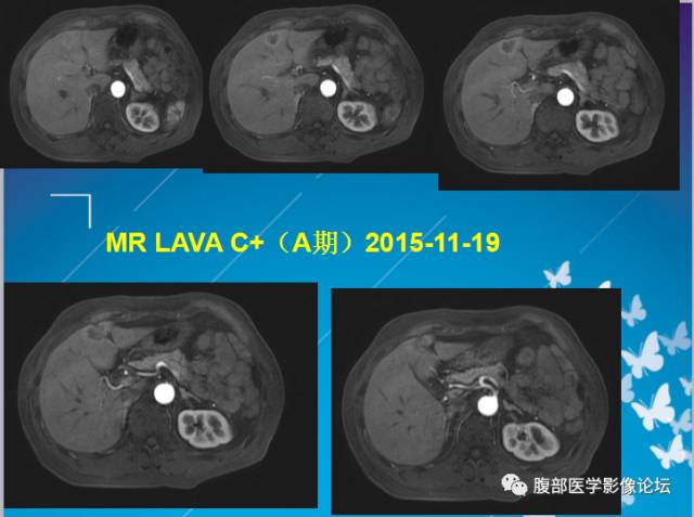 【病例】肝左叶胆管细胞癌1例CT及MR影像表现 【病例】肝左叶胆管细胞癌1例CT及MR影像表现