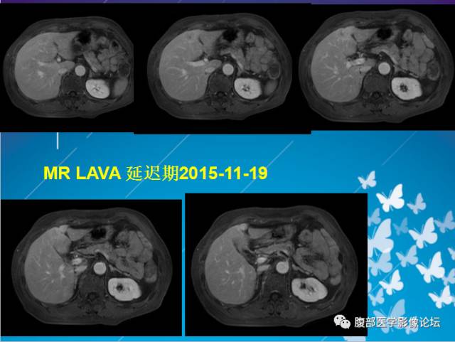 【病例】肝左叶胆管细胞癌1例CT及MR影像表现 【病例】肝左叶胆管细胞癌1例CT及MR影像表现