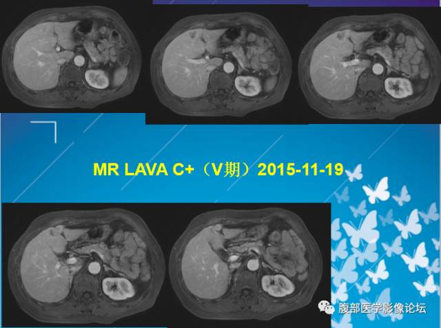 【病例】肝左叶胆管细胞癌1例CT及MR影像表现 【病例】肝左叶胆管细胞癌1例CT及MR影像表现