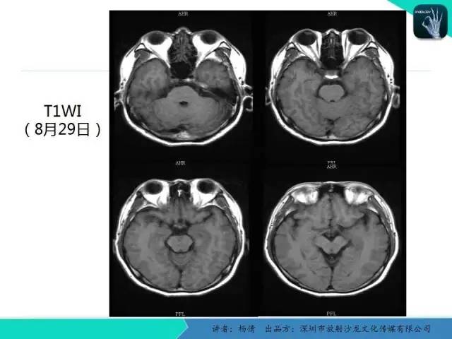 【病例】病毒性脑炎1例MR影像表现