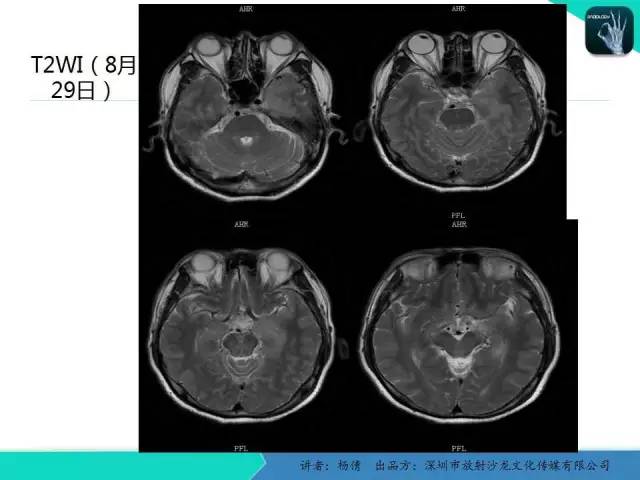【病例】病毒性脑炎1例MR影像表现