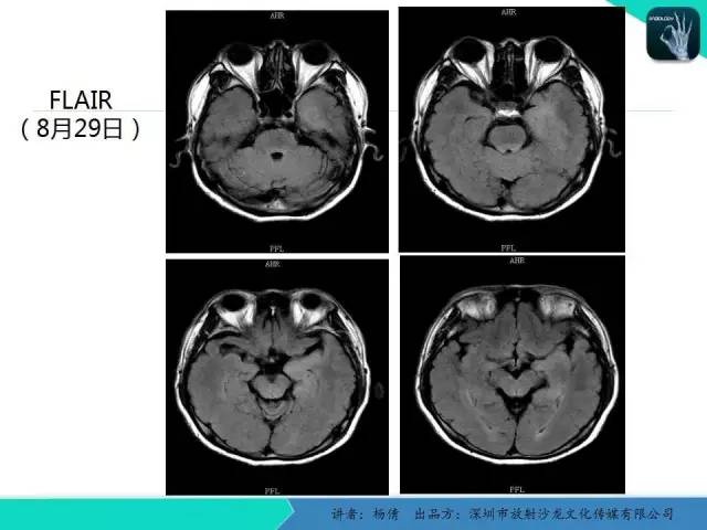 【病例】病毒性脑炎1例MR影像表现