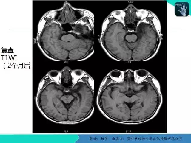 【病例】病毒性脑炎1例MR影像表现
