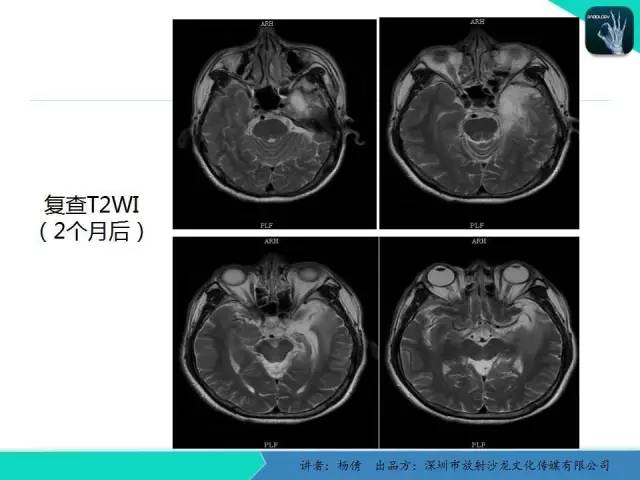 【病例】病毒性脑炎1例MR影像表现