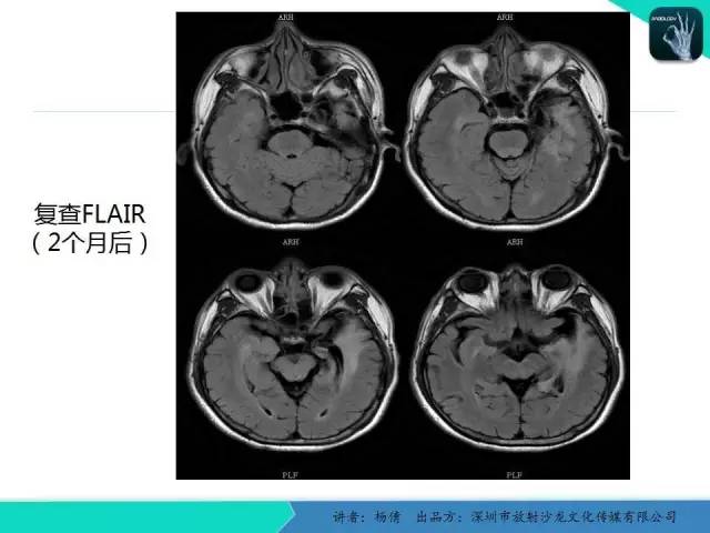 【病例】病毒性脑炎1例MR影像表现