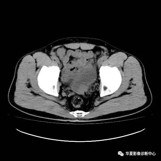 【病例】膀胱粘膜下平滑肌瘤一例CT影像表现 【病例】膀胱粘膜下平滑肌瘤一例CT影像表现