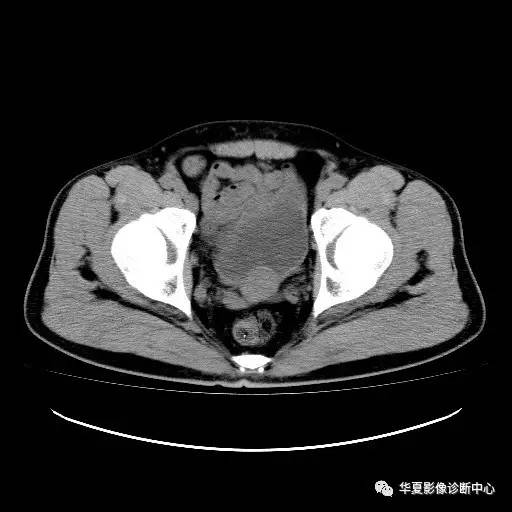 【病例】膀胱粘膜下平滑肌瘤一例CT影像表现 【病例】膀胱粘膜下平滑肌瘤一例CT影像表现