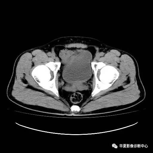 【病例】膀胱粘膜下平滑肌瘤一例CT影像表现 【病例】膀胱粘膜下平滑肌瘤一例CT影像表现
