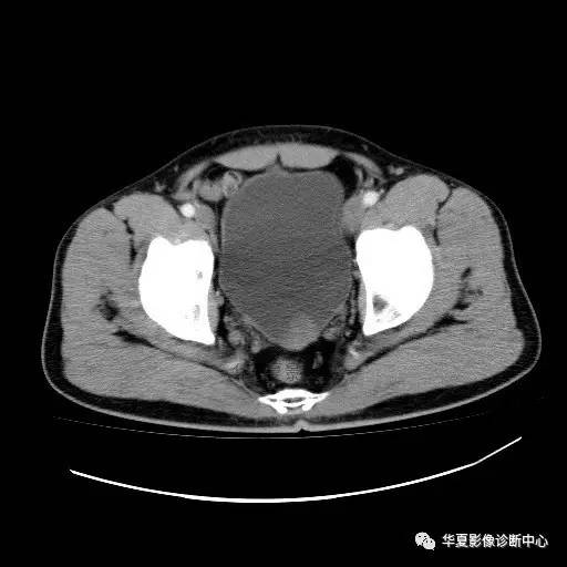 【病例】膀胱粘膜下平滑肌瘤一例CT影像表现 【病例】膀胱粘膜下平滑肌瘤一例CT影像表现