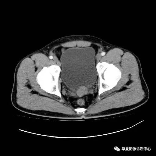 【病例】膀胱粘膜下平滑肌瘤一例CT影像表现 【病例】膀胱粘膜下平滑肌瘤一例CT影像表现