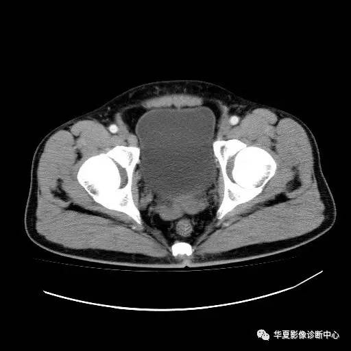 【病例】膀胱粘膜下平滑肌瘤一例CT影像表现 【病例】膀胱粘膜下平滑肌瘤一例CT影像表现