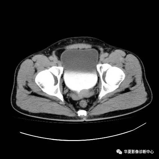 【病例】膀胱粘膜下平滑肌瘤一例CT影像表现 【病例】膀胱粘膜下平滑肌瘤一例CT影像表现