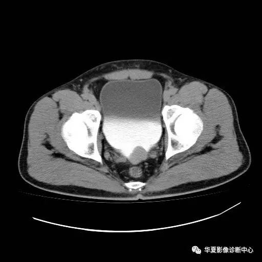 【病例】膀胱粘膜下平滑肌瘤一例CT影像表现 【病例】膀胱粘膜下平滑肌瘤一例CT影像表现