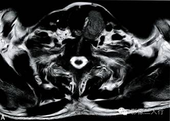 【病例】甲状旁腺腺癌1例MR影像分析