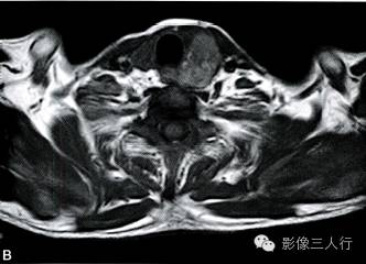 【病例】甲状旁腺腺癌1例MR影像分析 【病例】甲状旁腺腺癌1例MR影像分析