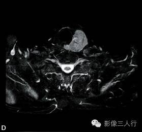 【病例】甲状旁腺腺癌1例MR影像分析 【病例】甲状旁腺腺癌1例MR影像分析