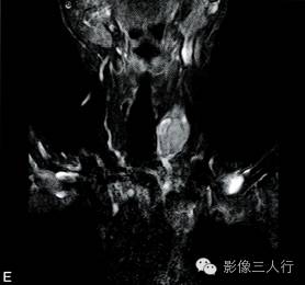 【病例】甲状旁腺腺癌1例MR影像分析 【病例】甲状旁腺腺癌1例MR影像分析