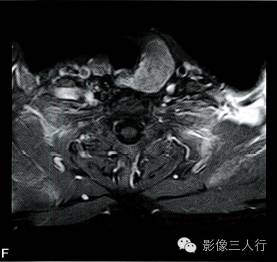 【病例】甲状旁腺腺癌1例MR影像分析