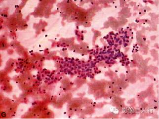 【病例】甲状旁腺腺癌1例MR影像分析 【病例】甲状旁腺腺癌1例MR影像分析
