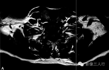 【病例】甲状旁腺腺癌1例MR影像分析 【病例】甲状旁腺腺癌1例MR影像分析