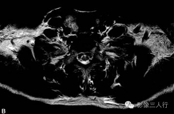 【病例】甲状旁腺腺癌1例MR影像分析 【病例】甲状旁腺腺癌1例MR影像分析