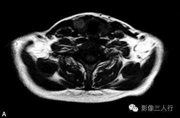 【病例】甲状旁腺腺癌1例MR影像分析 【病例】甲状旁腺腺癌1例MR影像分析