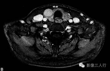 【病例】甲状旁腺腺癌1例MR影像分析 【病例】甲状旁腺腺癌1例MR影像分析