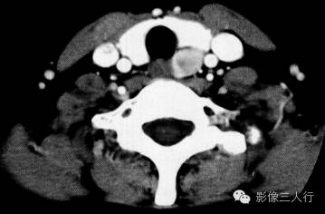 【病例】甲状旁腺腺癌1例MR影像分析 【病例】甲状旁腺腺癌1例MR影像分析