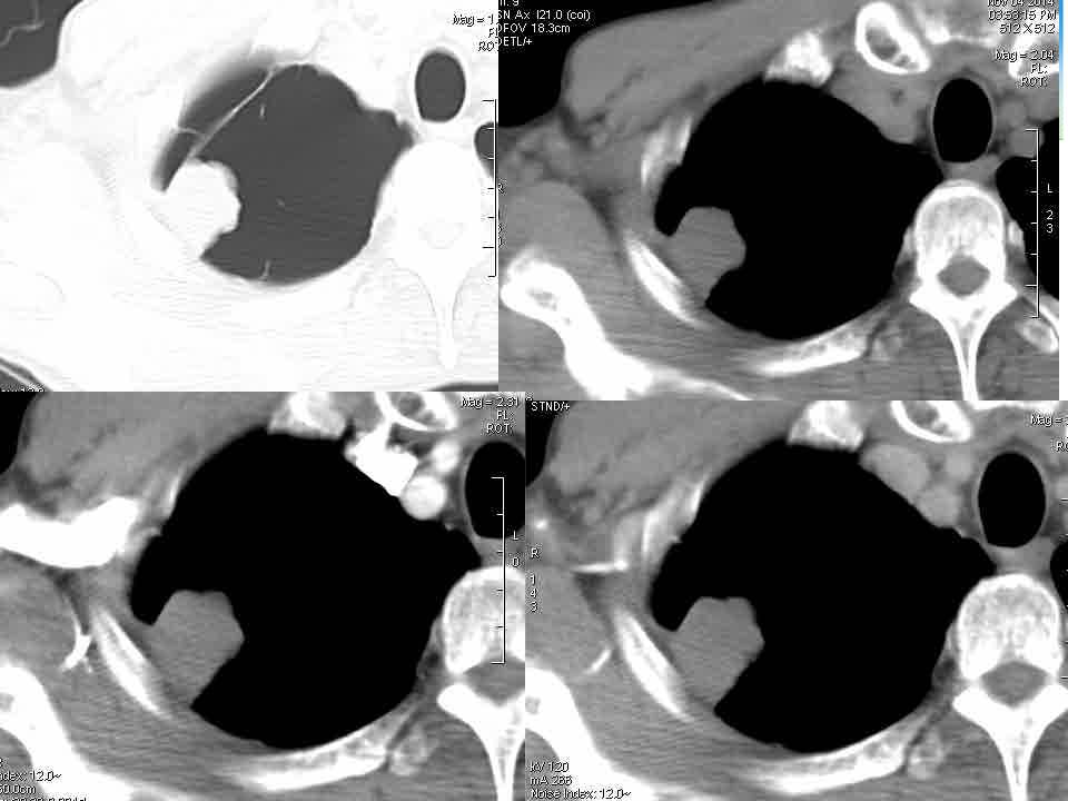 【病例】右肺上叶PNET一1例CT