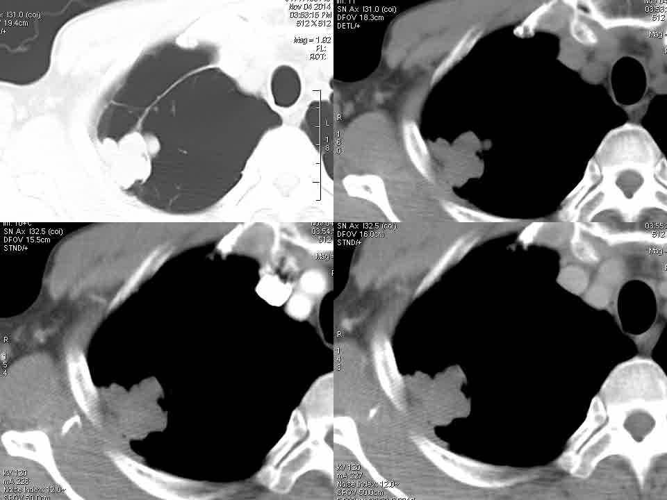 【病例】右肺上叶PNET一1例CT