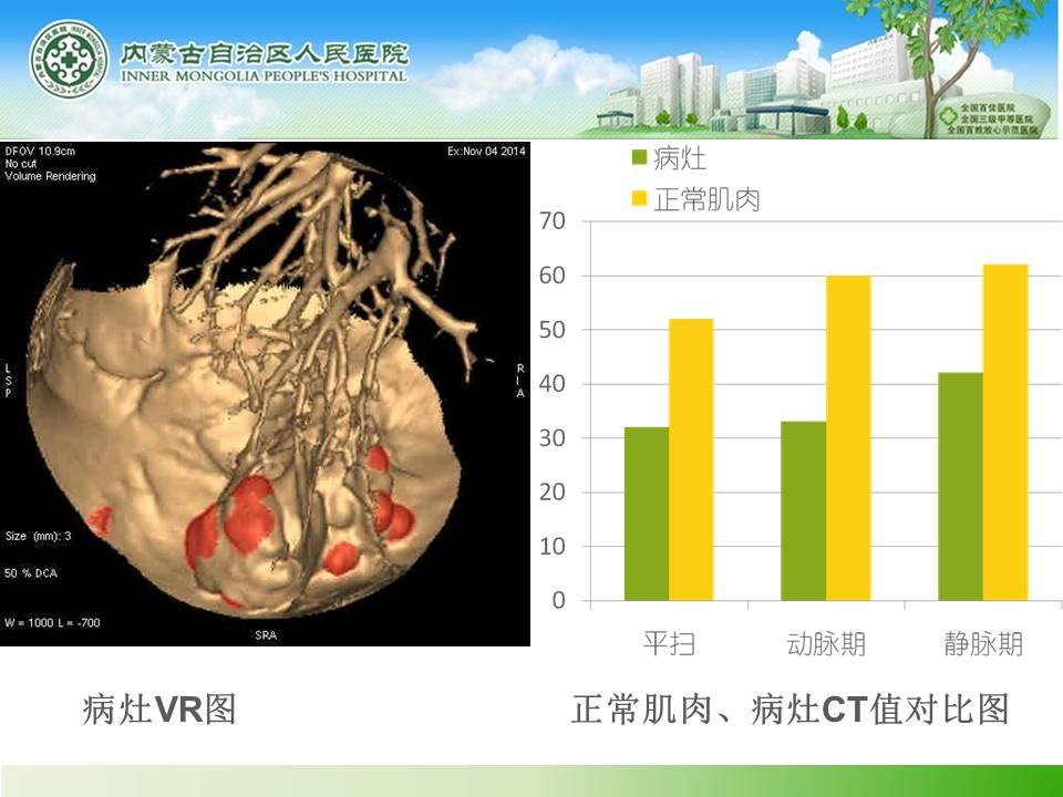 【病例】右肺上叶PNET一1例CT