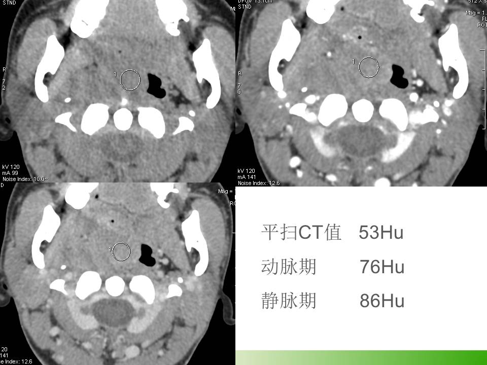 【病例】右侧扁桃体淋巴瘤1例CT及MR