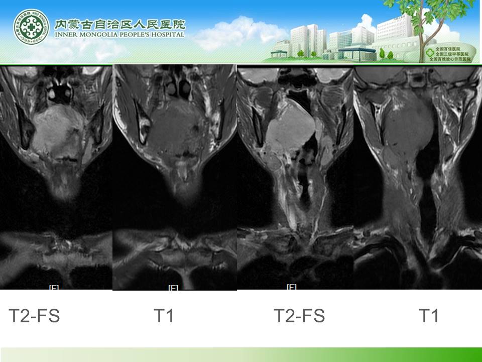 【病例】右侧扁桃体淋巴瘤1例CT及MR