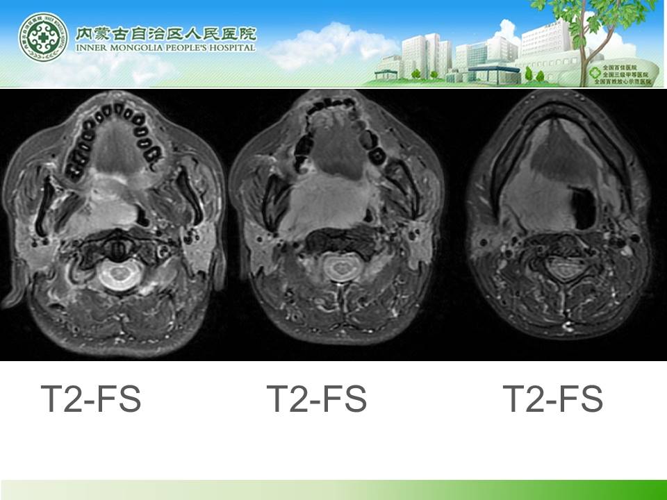 【病例】右侧扁桃体淋巴瘤1例CT及MR